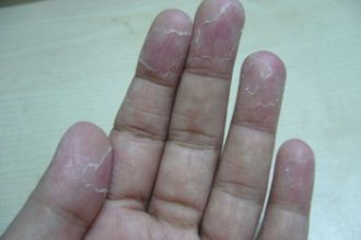 Penyebab telapak tangan mengelupas & cara mengatasinya